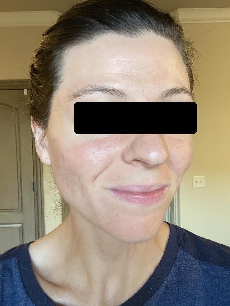 breakoutLabs Review: How Lindsay Cleared Her Skin Before Her Wedding