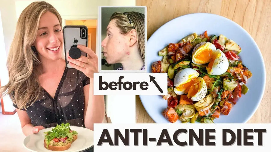 Hormonal Acne Diet - BreakoutLabs