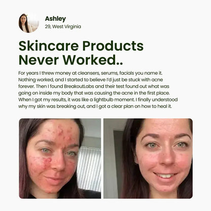 BreakoutLabs Acne Root Cause Test BreakoutLabs