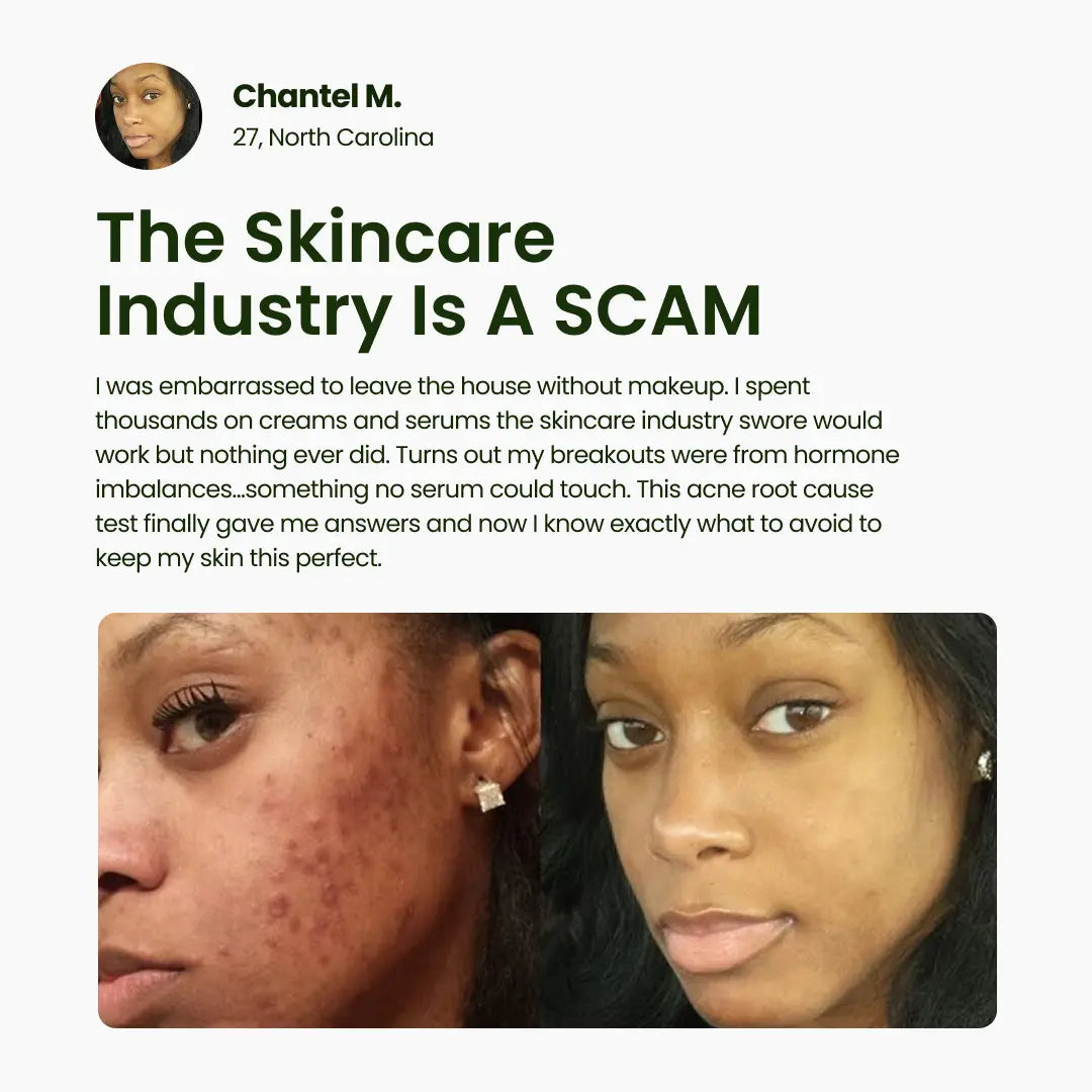 BreakoutLabs Acne Root Cause Test BreakoutLabs