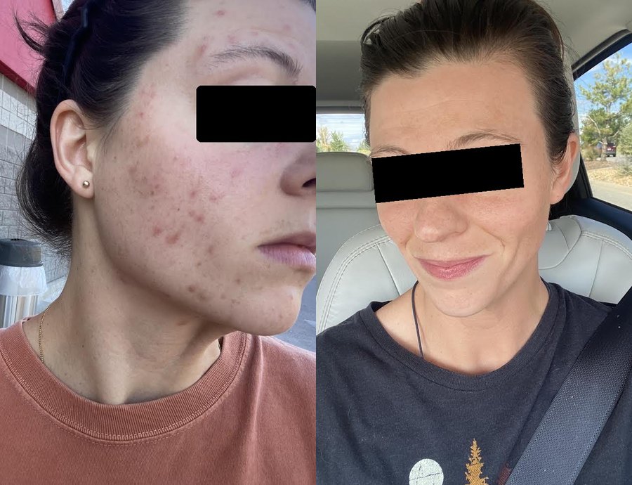 Lindsay P. before and after